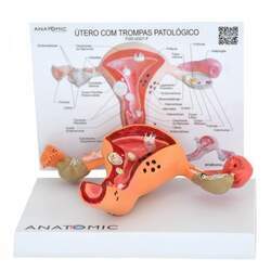 Útero com Trompas Patológico - Anatomic - TGD-0327-F